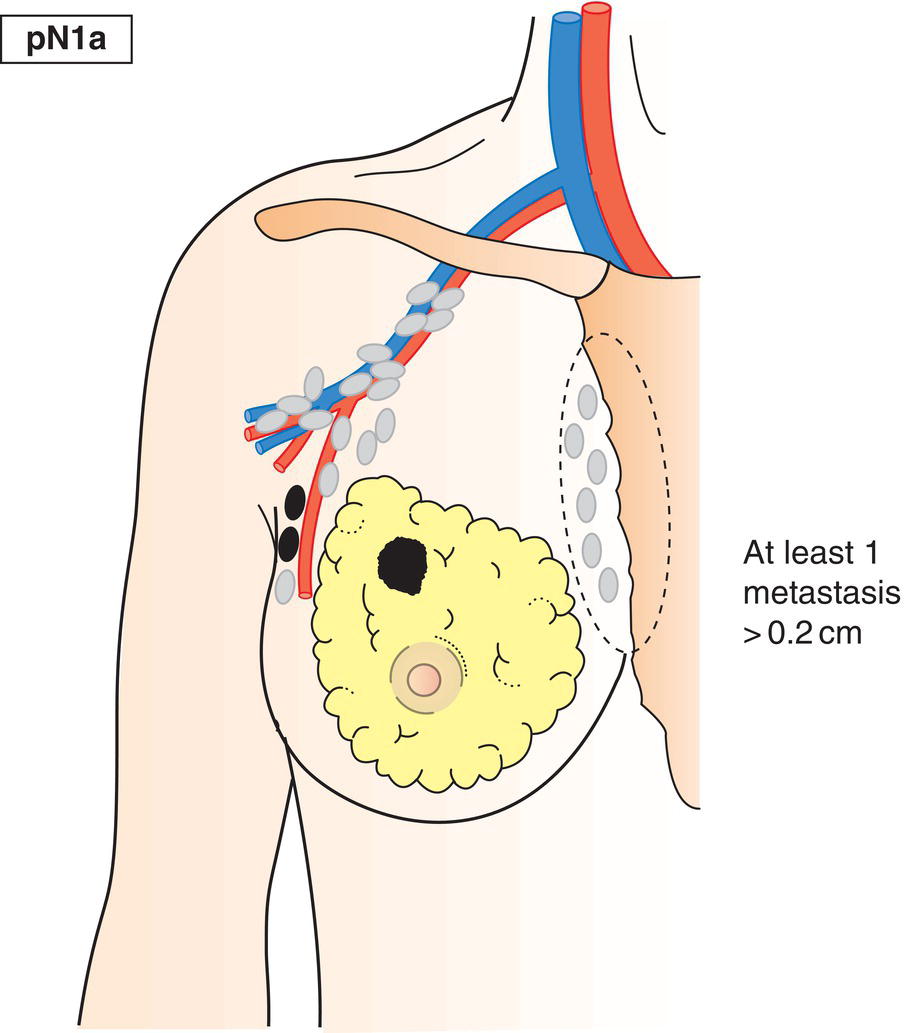 Schematic illustration of Metastasis in 1–3 axillary lymph node(s), including at least one larger than 2mm in greatest dimension.