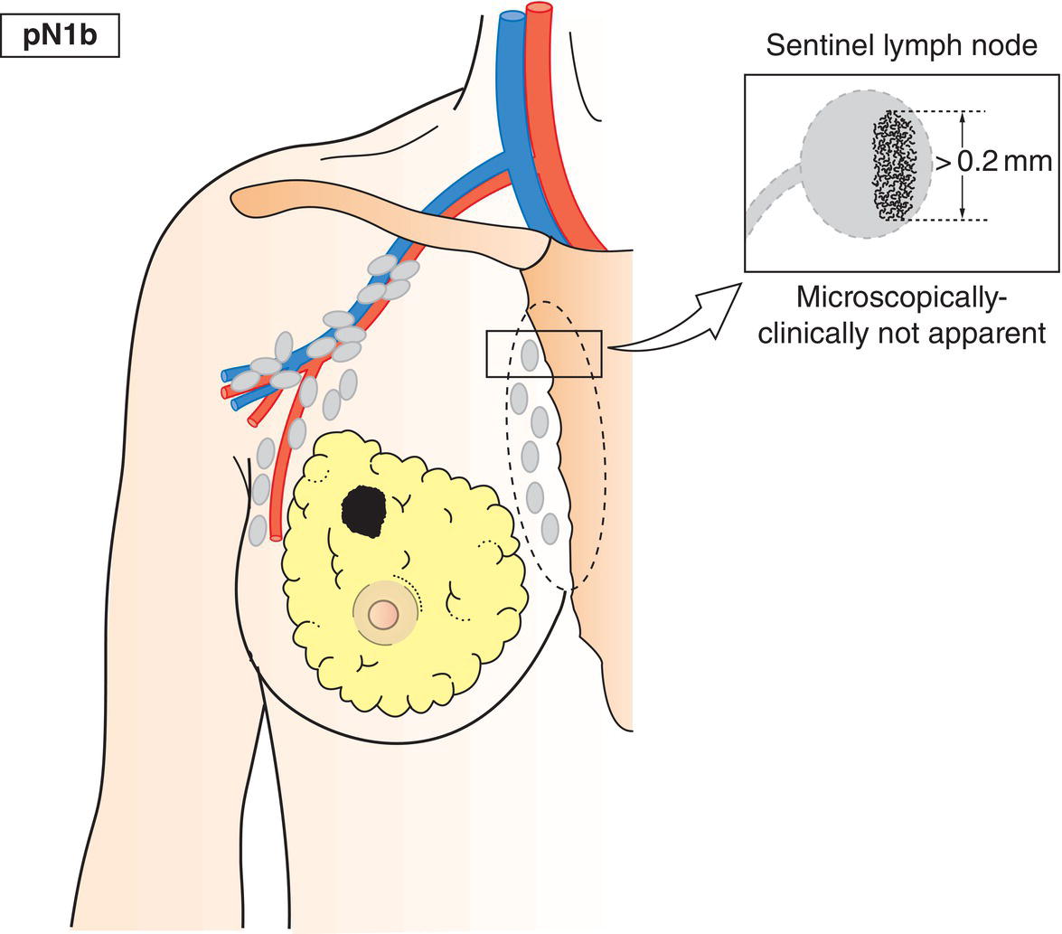 Schematic illustration of Internal mammary lymph nodes not clinically detected.