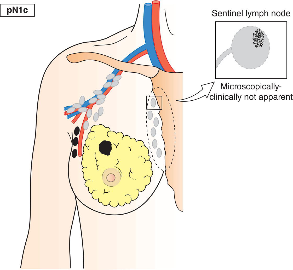 Schematic illustration of Metastasis in 1–3 axillary lymph nodes and internal mammary lymph nodes not clinically detected.