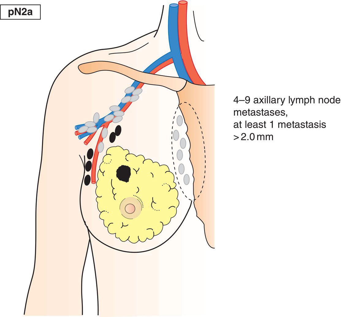 Schematic illustration of Metastasis in 4–9 axillary lymph nodes, including at least one that is larger than 2mm.