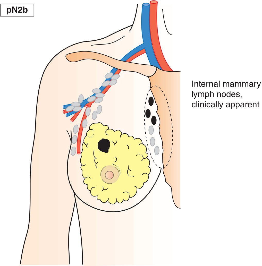 Schematic illustration of Metastasis in clinically detected internal mammary lymph node(s), in the absence of axillary lymph node metastasis.