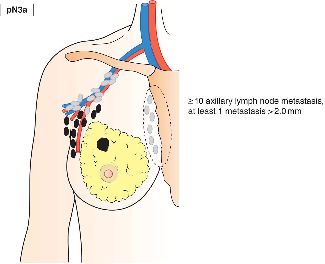 Schematic illustration of Metastasis in 10 or more axillary lymph nodes or metastasis in infraclavicular lymph nodes or Level III lymph nodes.