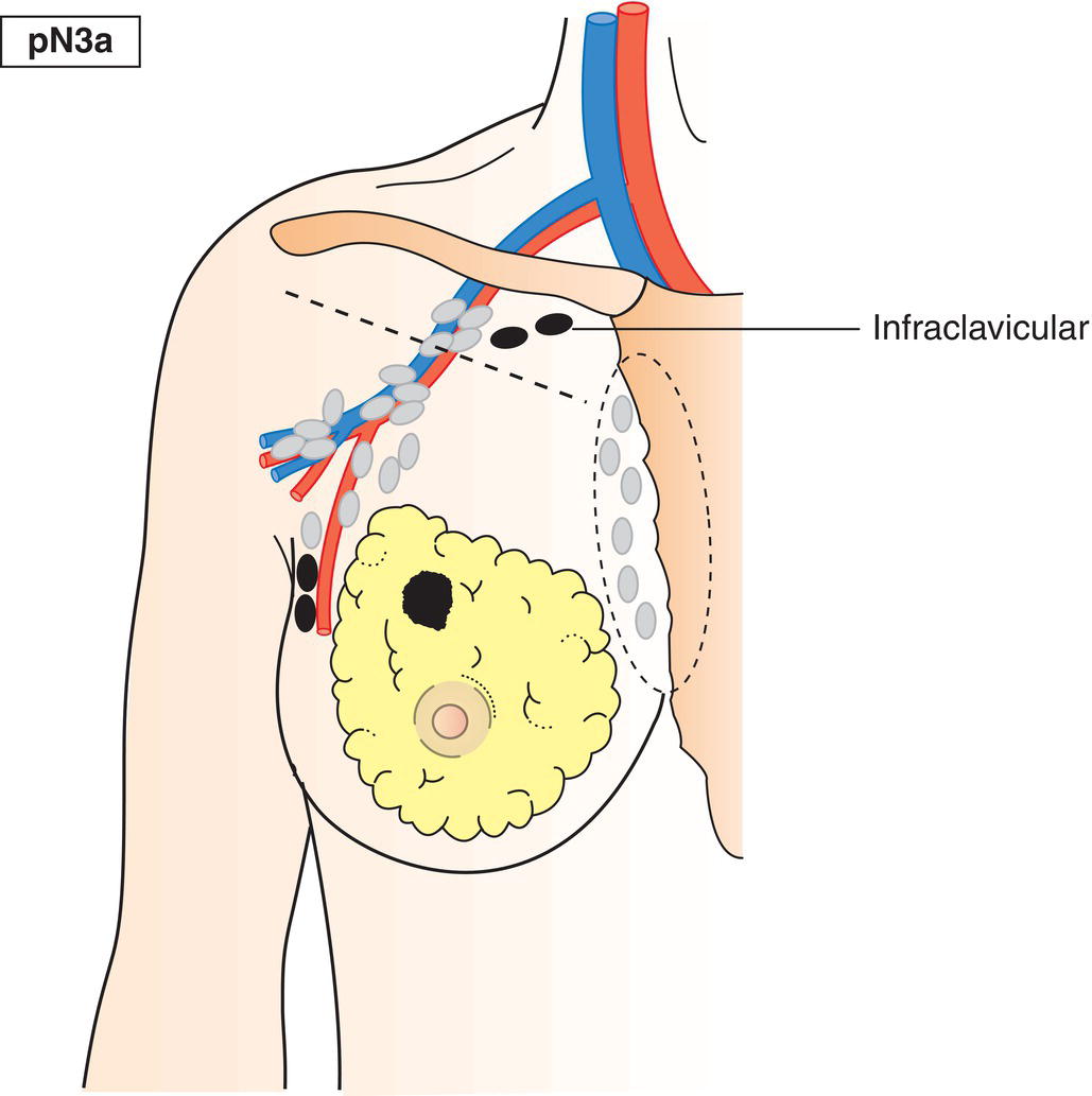 Schematic illustration of Metastasis in 10 or more axillary lymph nodes or metastasis in infraclavicular lymph nodes or Level III lymph nodes.