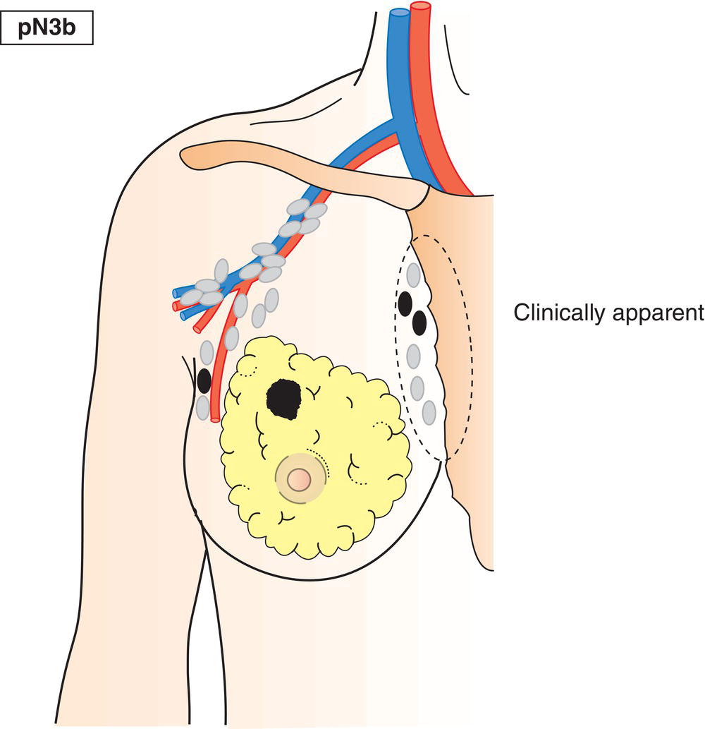 Schematic illustration of Metastasis in clinically detected internal mammary lymph node(s) in the presence of positive axillary lymph node(s).