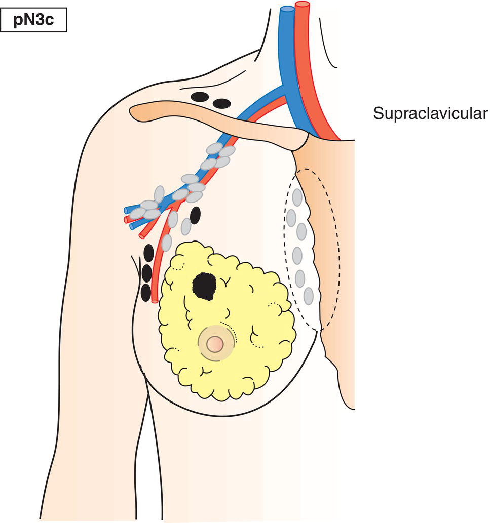 Schematic illustration of Metastasis in supraclavicular lymph node(s).