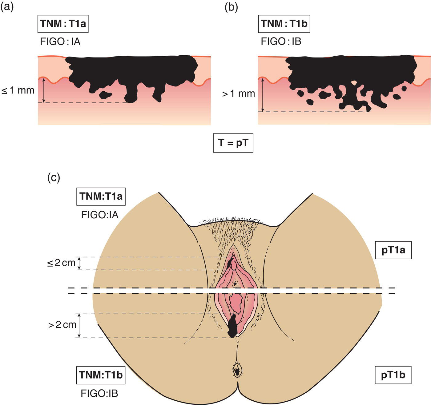 Schematic illustration of tumour 2 cm or less in greatest dimension and with stromal invasion no greater than 1.0 mm, Tumour greater than 2 cm or with stromal invasion greater than 1 mm, Tumour confined to vulva or vulva and perineum.