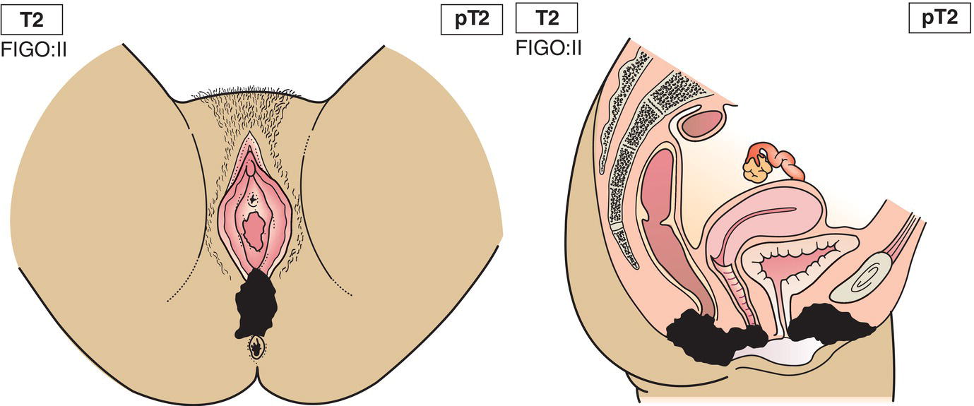 Schematic illustration of tumour invades any of the following perineal structures: lower third urethra, lower third vagina, anus.