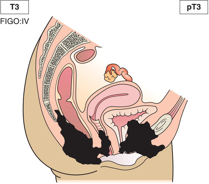 Schematic illustration of tumour invades any of the following perineal structures: upper 2/3 urethra, upper 2/3 vagina, bladder mucosa, rectal mucosa; or fixed to pelvic bone.