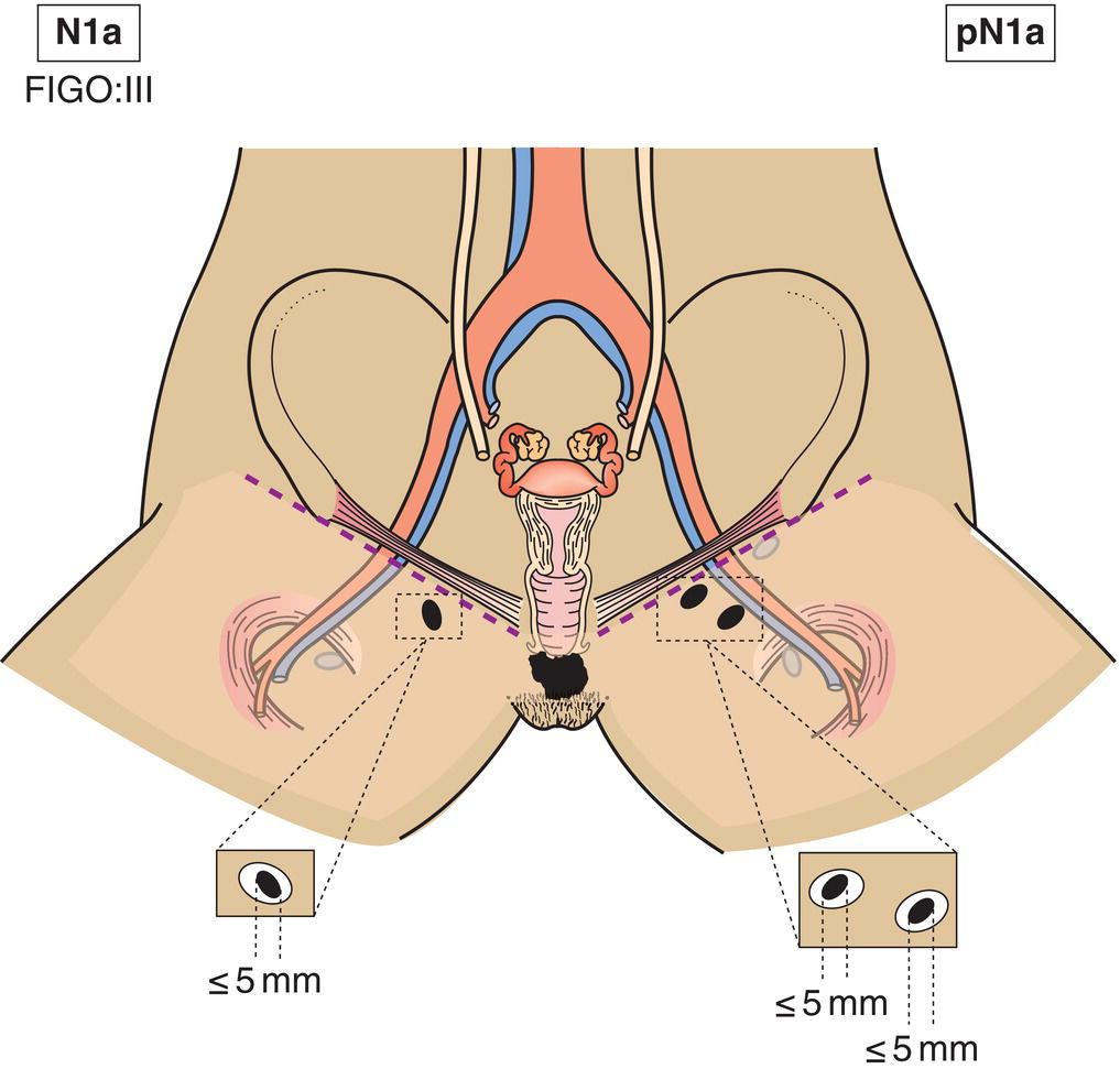 Schematic illustration of One or two lymph node metastasis less than 5 mm.