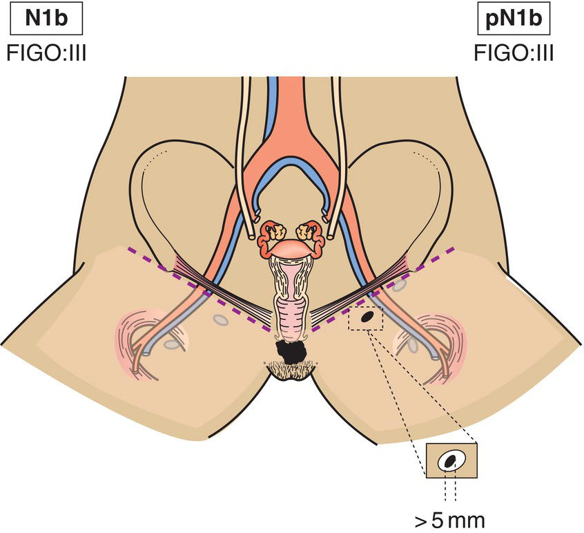 Schematic illustration of One lymph node metastases 5 mm or greater.