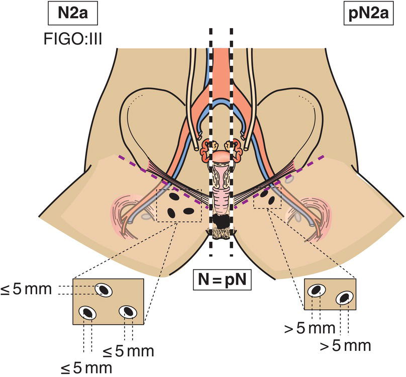 Schematic illustration of Three or more lymph node metastases each less than 5 mm.