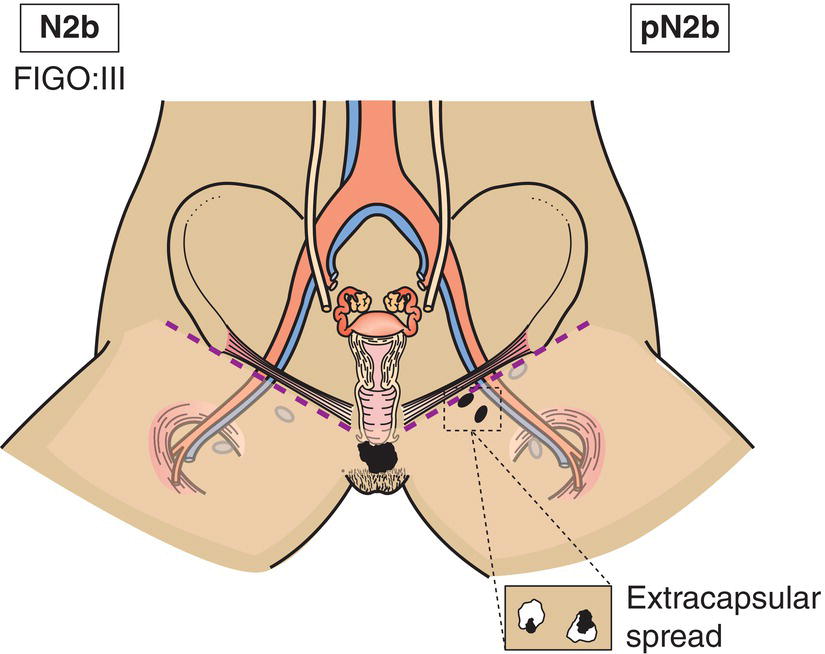 Schematic illustration of Two or more lymph node metastases 5 mm or greater.