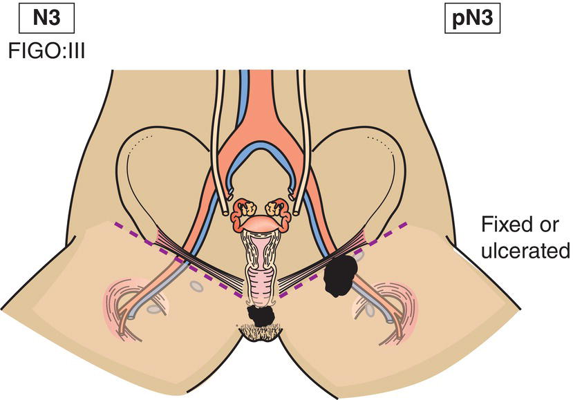 Schematic illustration of Fixed or ulcerated regional lymph node metastasis.