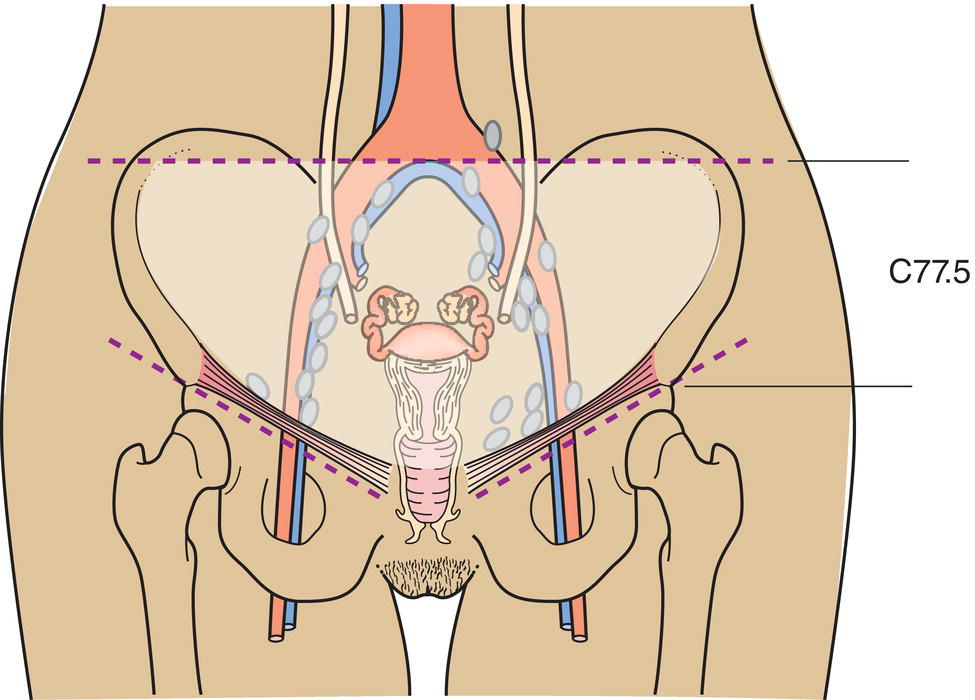 Schematic illustration of the pelvic nodes including obdurator, internal iliac, external iliac, and pelvic nodes, NOS.