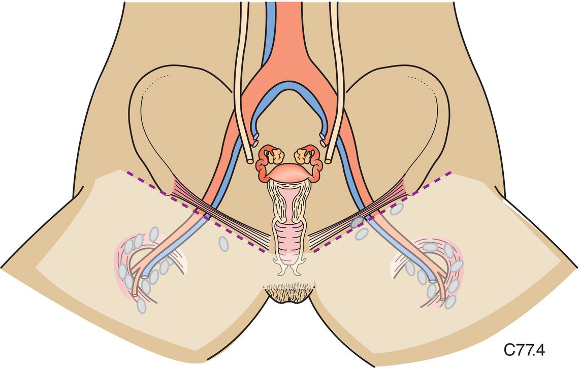 Schematic illustration of the inguinal and femoral nodes.