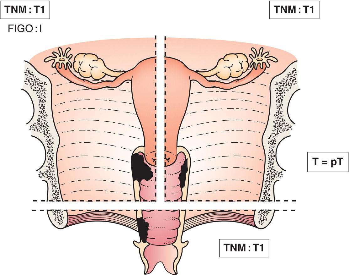 Schematic illustration of tumour confined to vagina.