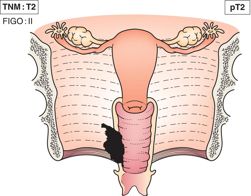 Schematic illustration of tumour invades paravaginal tissues.