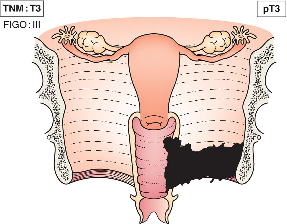 Schematic illustration of tumour extends to pelvic wall.