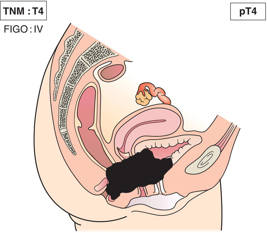 Schematic illustration of tumour invades mucosa of bladder
or rectum, or extends beyond the true pelvis.