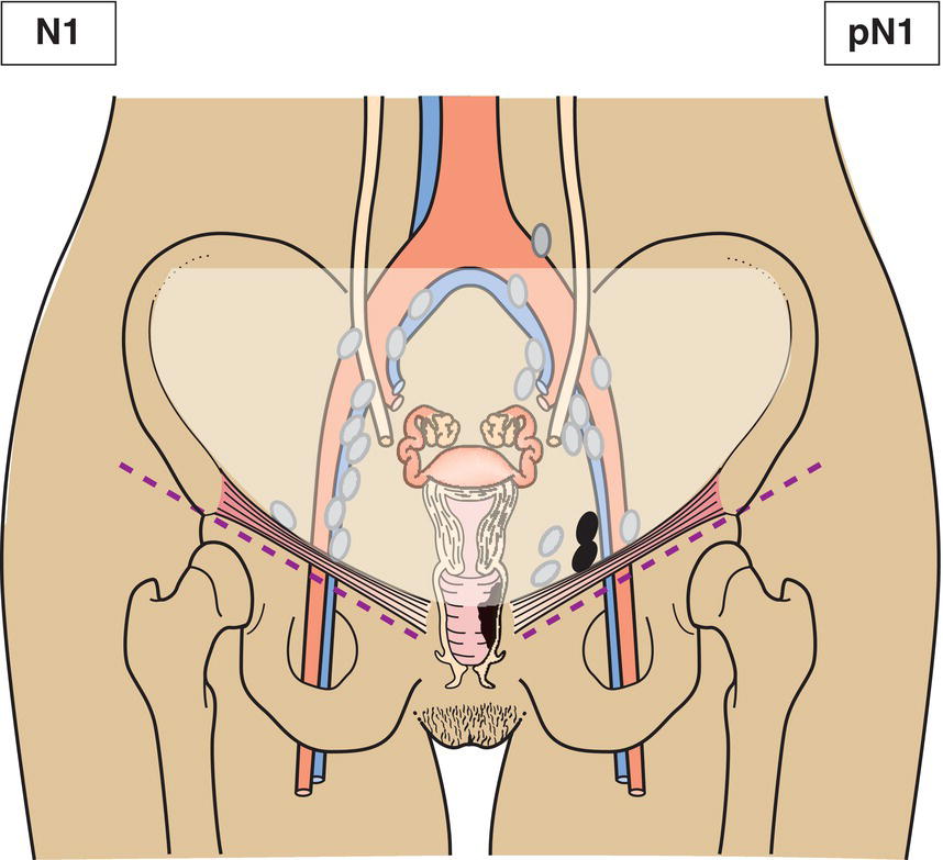 Schematic illustration of Regional lymph node metastasis.