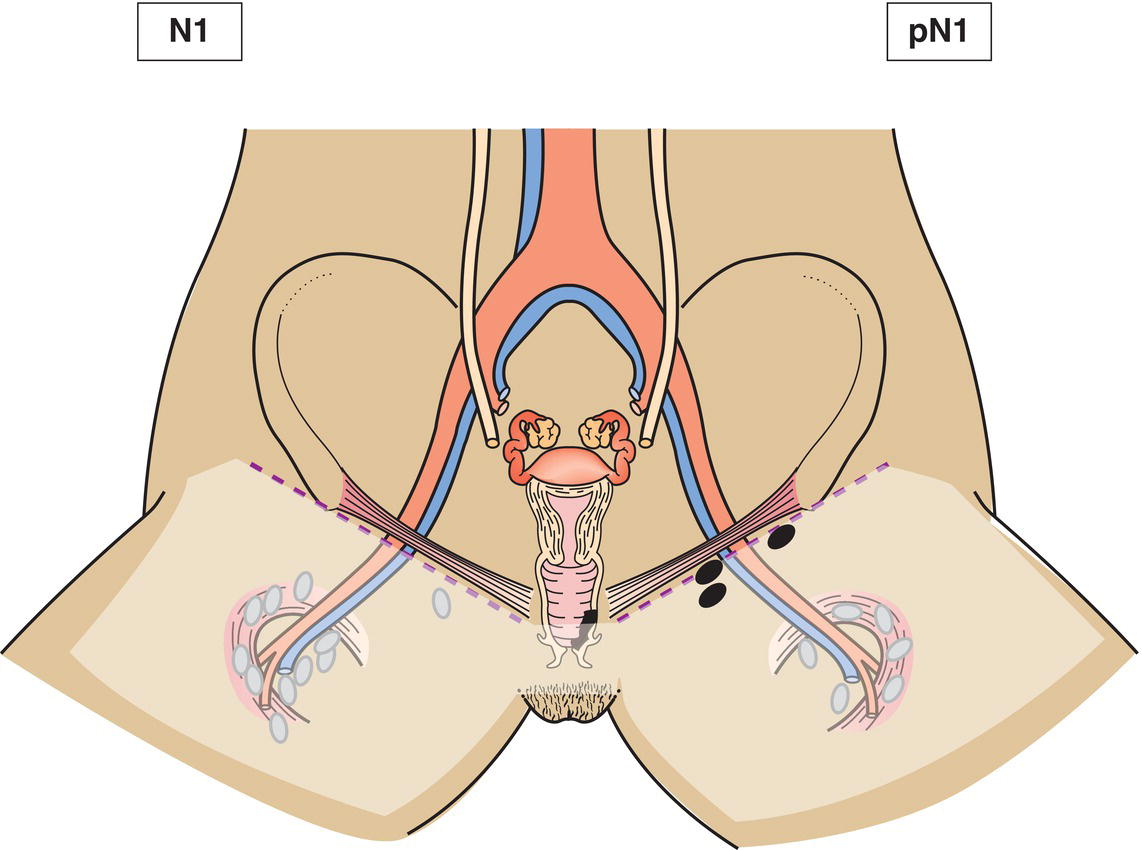 Schematic illustration of Regional lymph node metastasis.