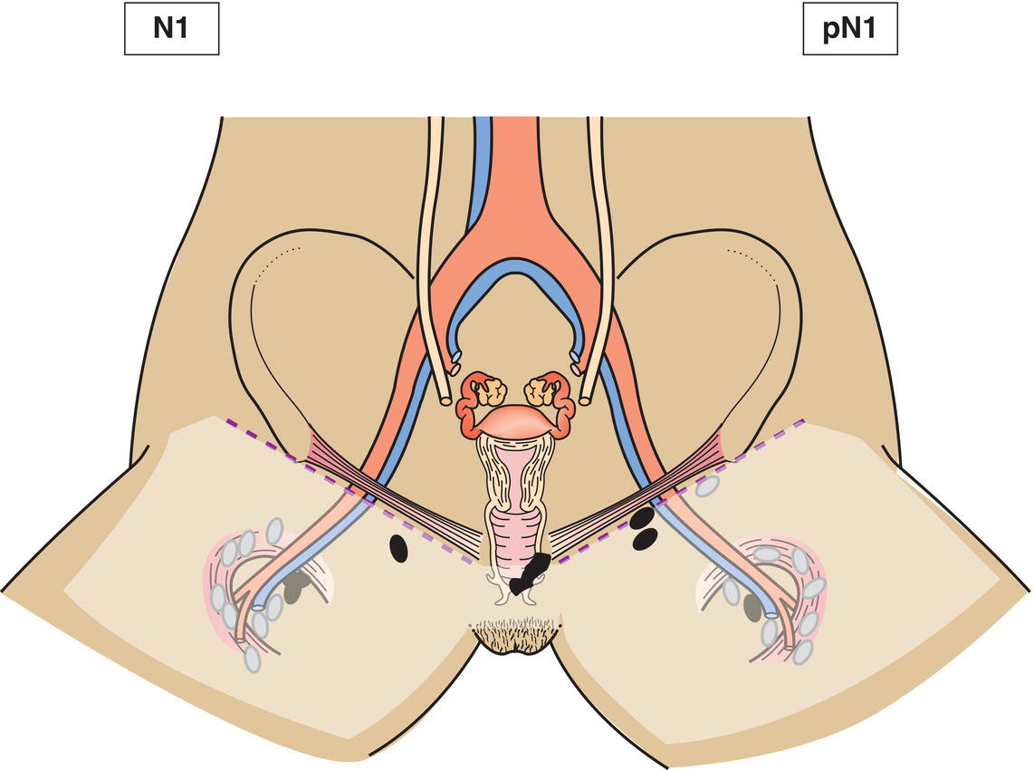 Schematic illustration of Regional lymph node metastasis.