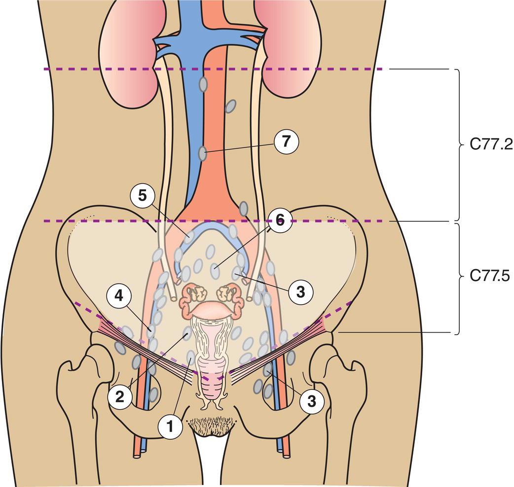 Schematic illustration of paracervical, parametrial, hypogastric, common and external iliac, presacral, lateral sacral nodes and para-aortic nodes.