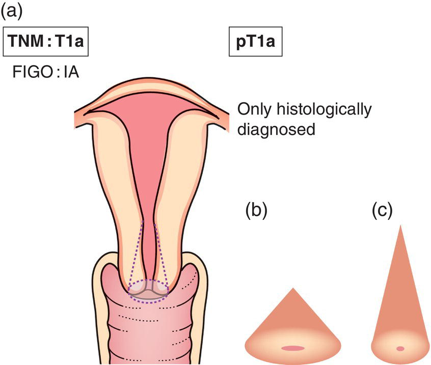 Schematic illustration of Invasive carcinoma diagnosed only by microscopy.