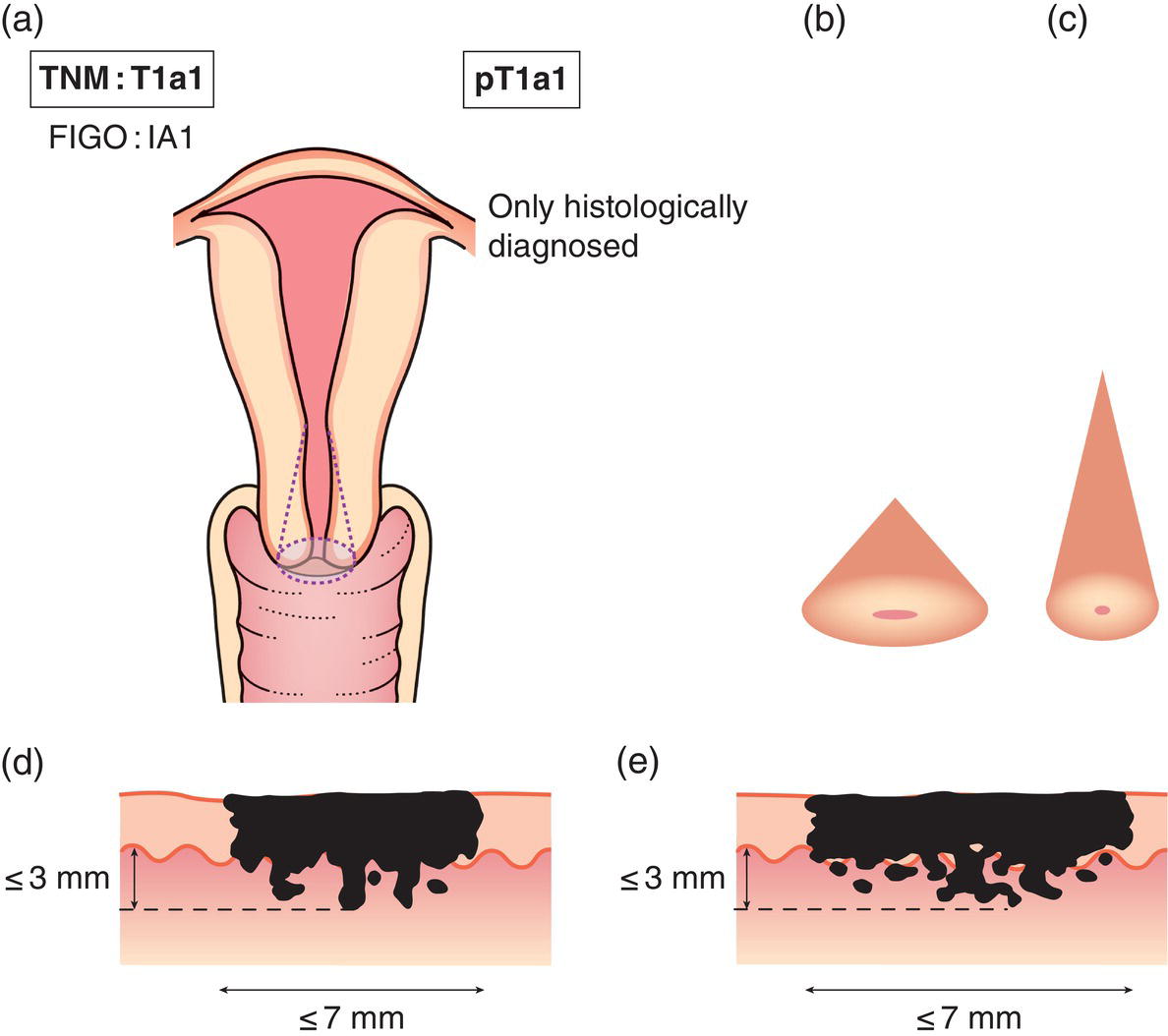 Schematic illustration of Stromal invasion with a maximal depth of 5.0 mm measured from the base of the epithelium and a horizontal spread of 7.0 mm or less.