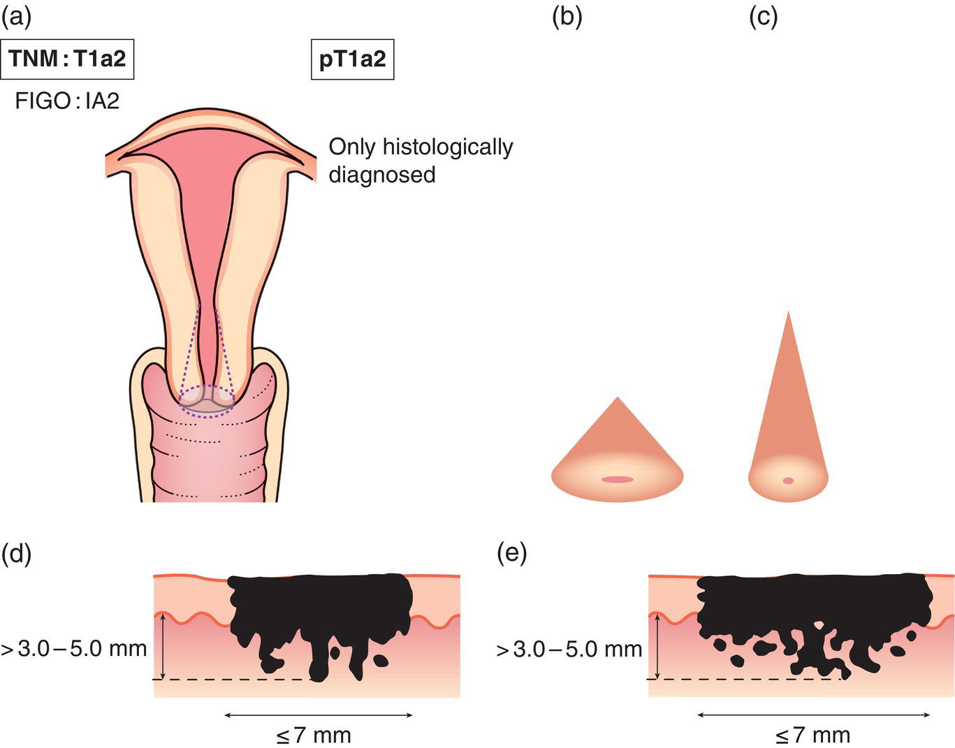 Schematic illustration of Measured stromal invasion more than 3.0 mm and not more than than 5.0 mm with a horizontal spread of 7.0 mm or less.