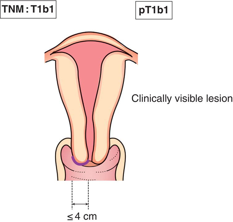 Schematic illustration of Clinically visible lesion confined to the cervix.