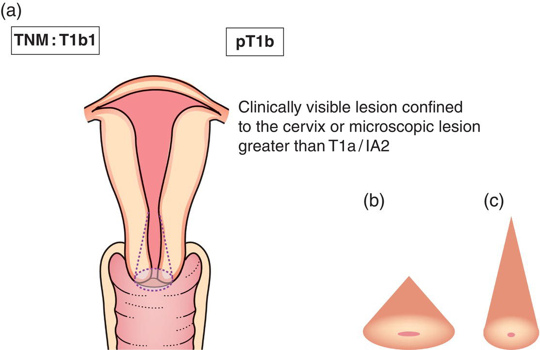 Schematic illustration of Clinically visible lesion 4.0 cm or less in greatest dimension.