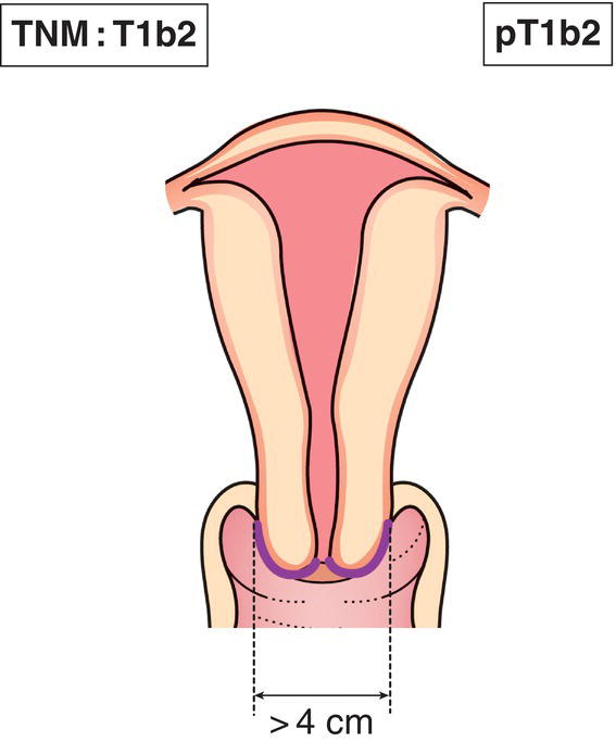 Schematic illustration of Clinically visible lesion confined to the cervix.