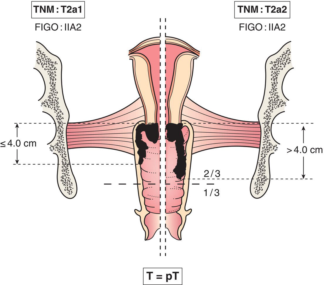 Schematic illustration of tumour invades beyond uterus but not to pelvic wall or to lower
third of vagina.