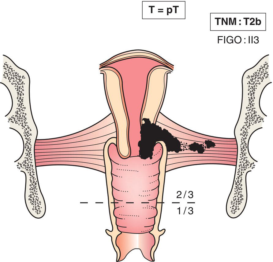 Schematic illustration of tumour with parametrial invasion.