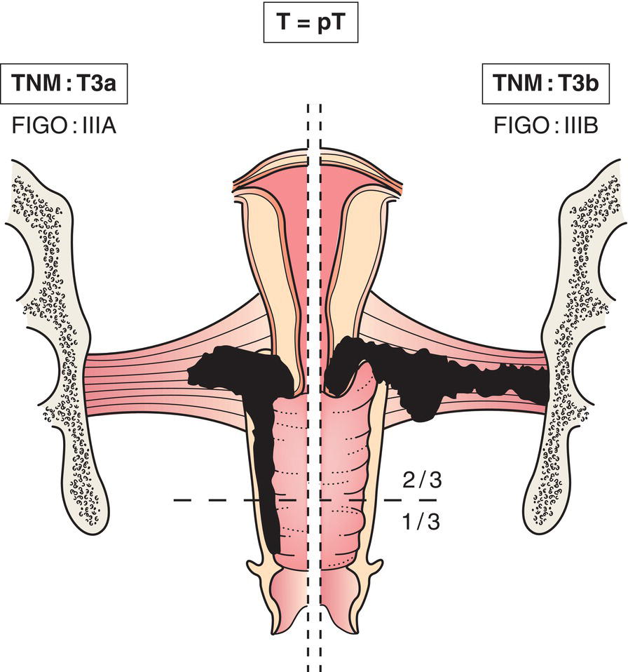 Schematic illustration of tumour extends to pelvic wall, involves lower third of vagina, causes
hydronephrosis or non-functioning kidney.