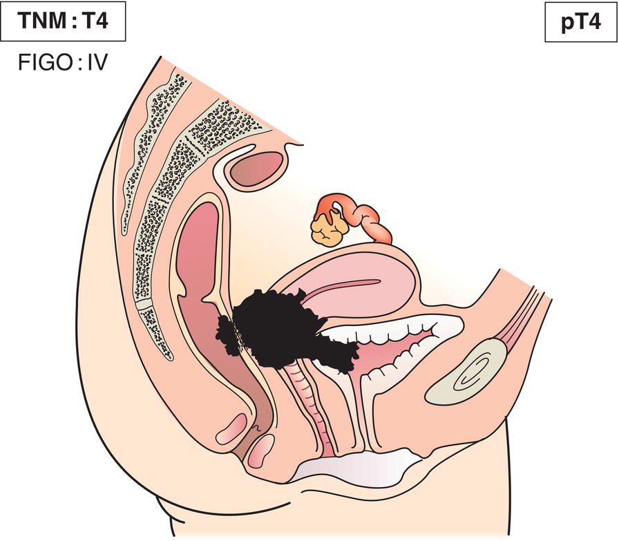 Schematic illustration of tumour invades mucosa of the bladder or rectum, or extends beyond
true pelvis.