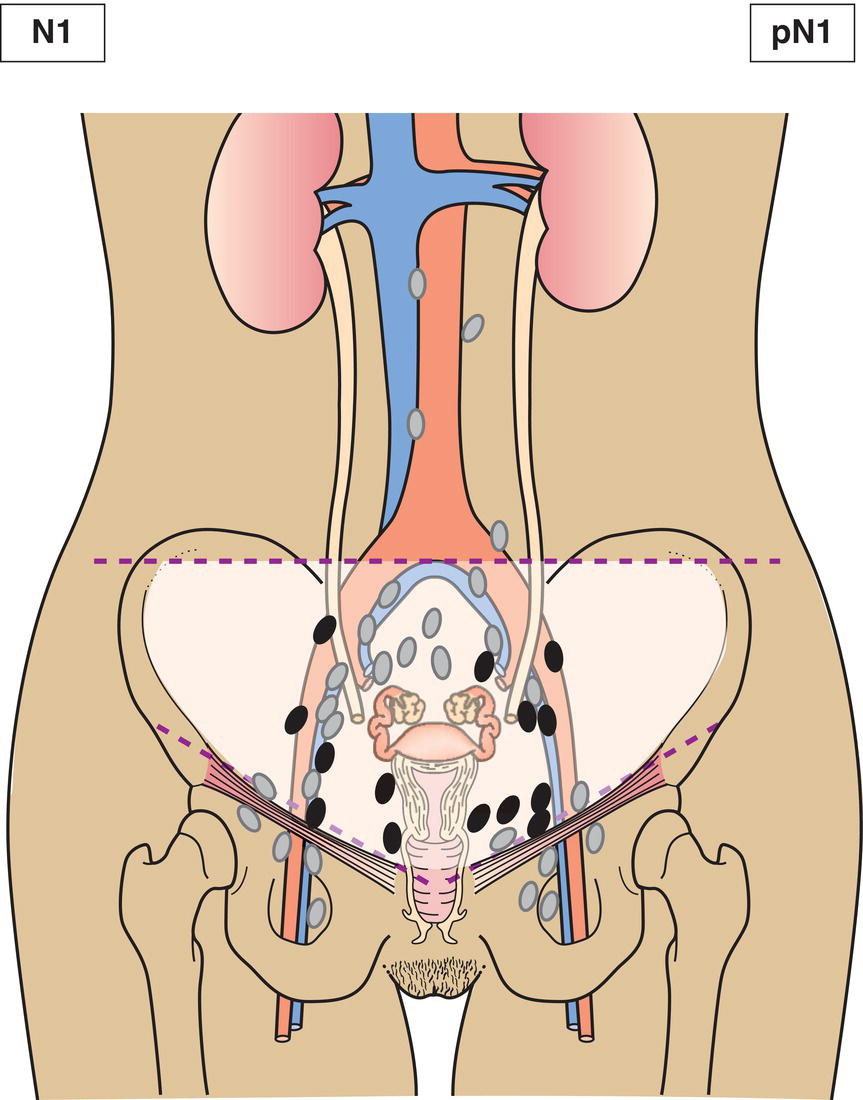 Schematic illustration of Regional lymph node metastasis.