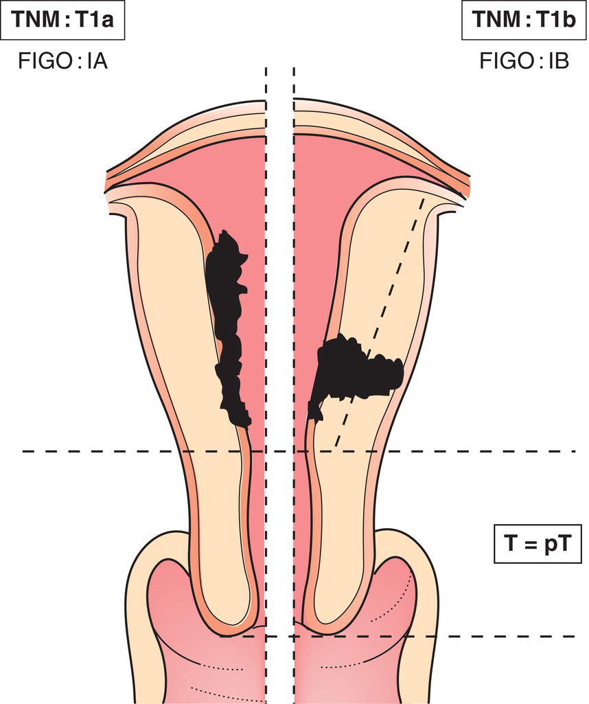 Schematic illustration of tumour confined to the corpus uteri.