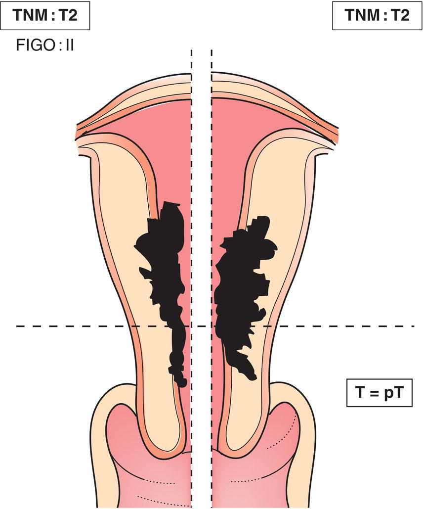 Schematic illustration of tumour invades cervical stroma, but does not extend
beyond the uterus.