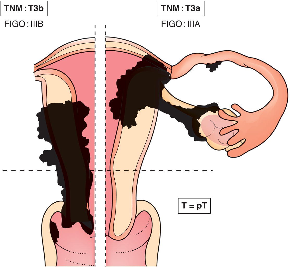 Schematic illustration of Vaginal or parametrial involvement.