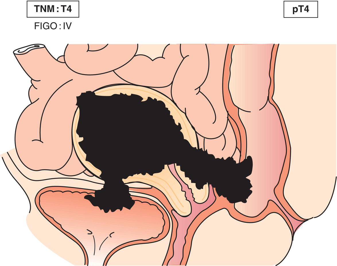 Schematic illustration of Metastasis to pelvic or para-aortic lymph nodes.