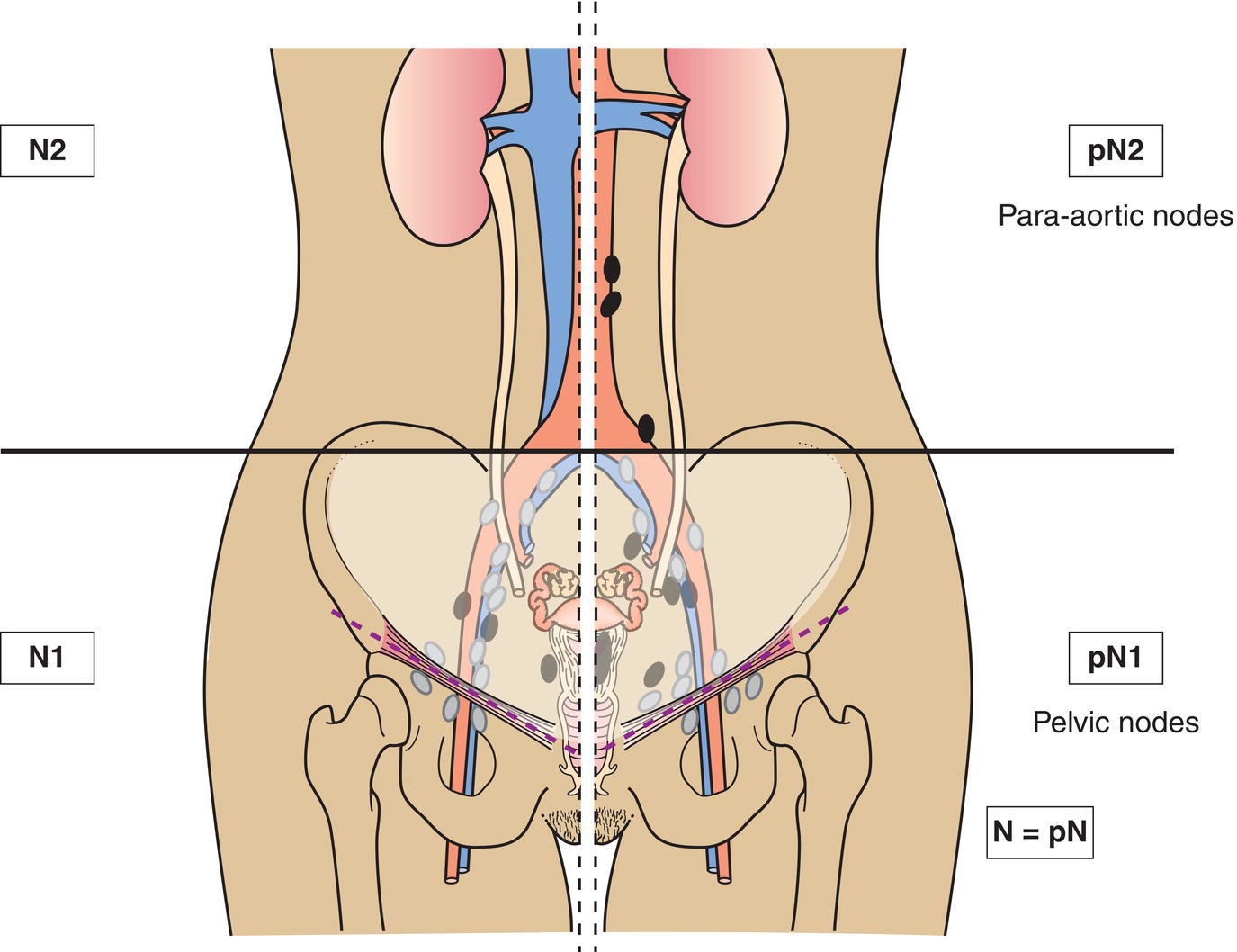 Schematic illustration of tumour invades bladder or bowel mucosa.