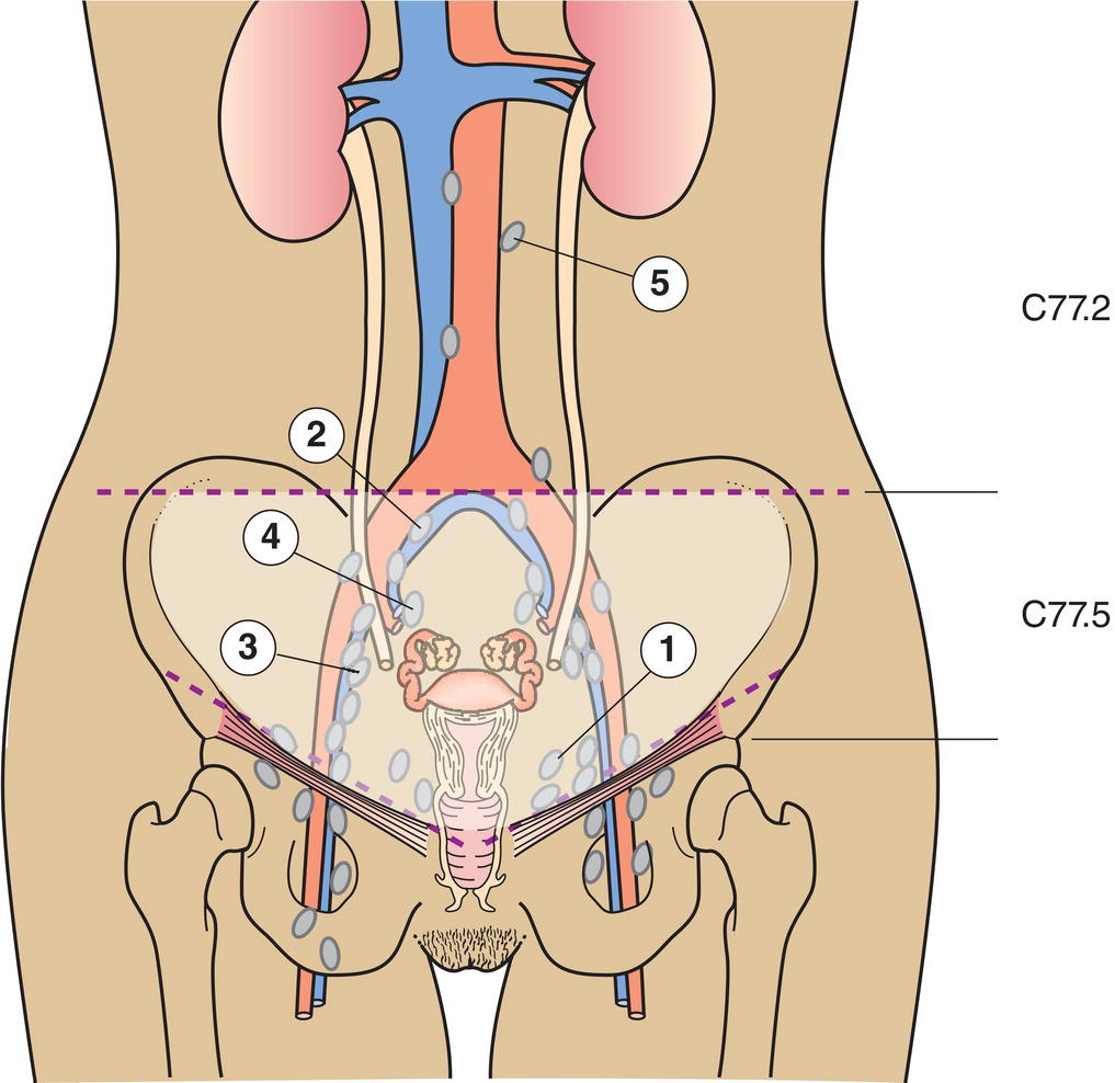 Schematic illustration of hypogastric, common iliac, external iliac, lateral sacral and para-aortic.