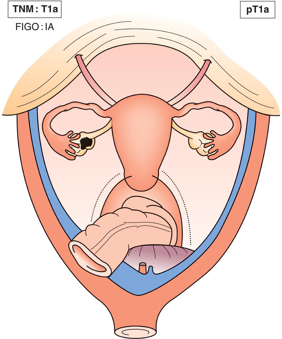 Schematic illustration of tumour limited to one ovary or fallopian tube; no tumour on ovarian or fallopian tube surface, no malignant cells in ascites or peritoneal washings.