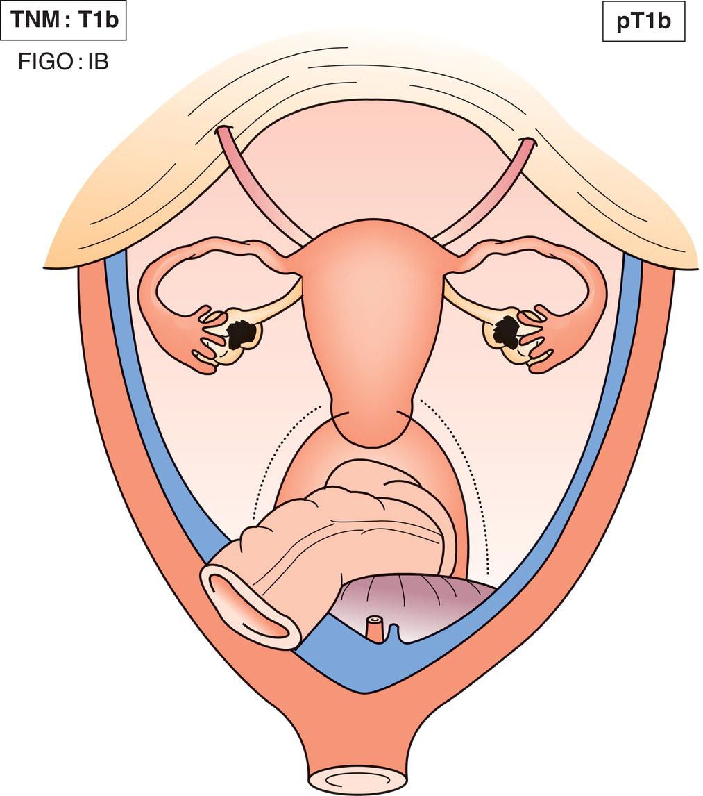 Schematic illustration of tumour limited to both ovaries or fallopian tubes.