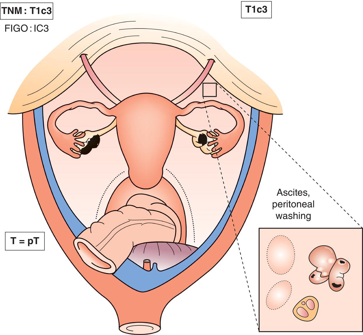 Schematic illustration of Malignant cells in ascites or peritoneal washings.