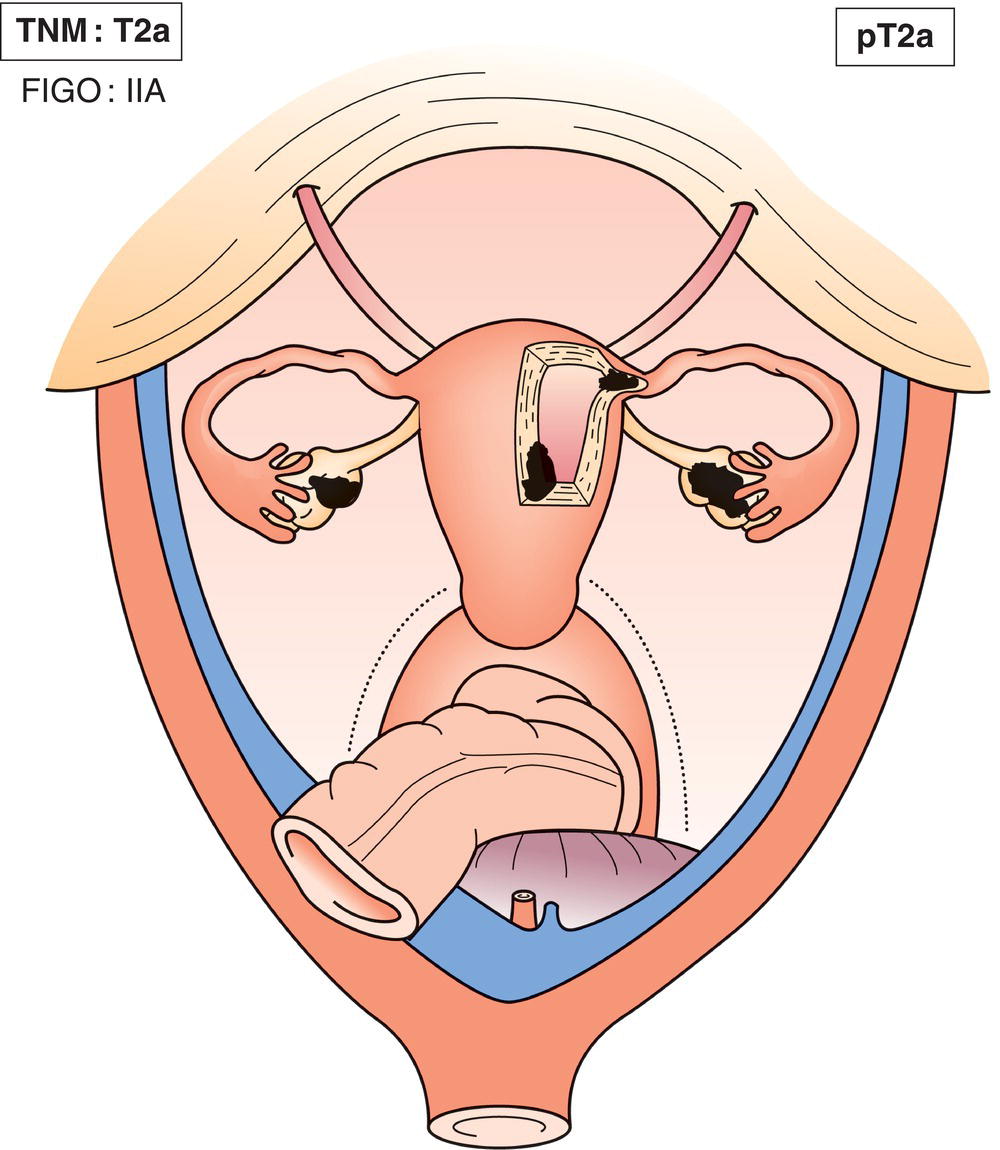 Schematic illustration of Extension and implants on uterus and fallopian tube(s) and or ovary(ies).