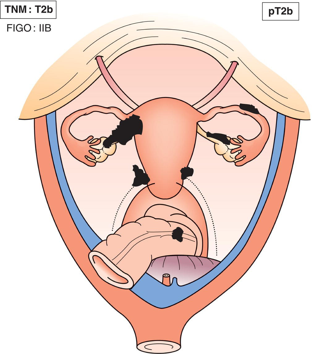 Schematic illustration of Extension to other pelvic tissues, including bowel within the pelvis.