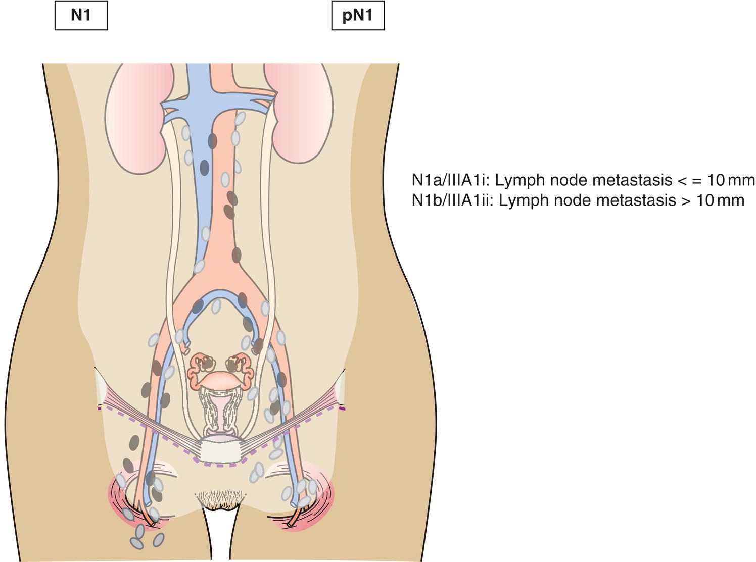 Schematic illustration of Lymph node metastasis not more than 10 mm in greatest dimension.